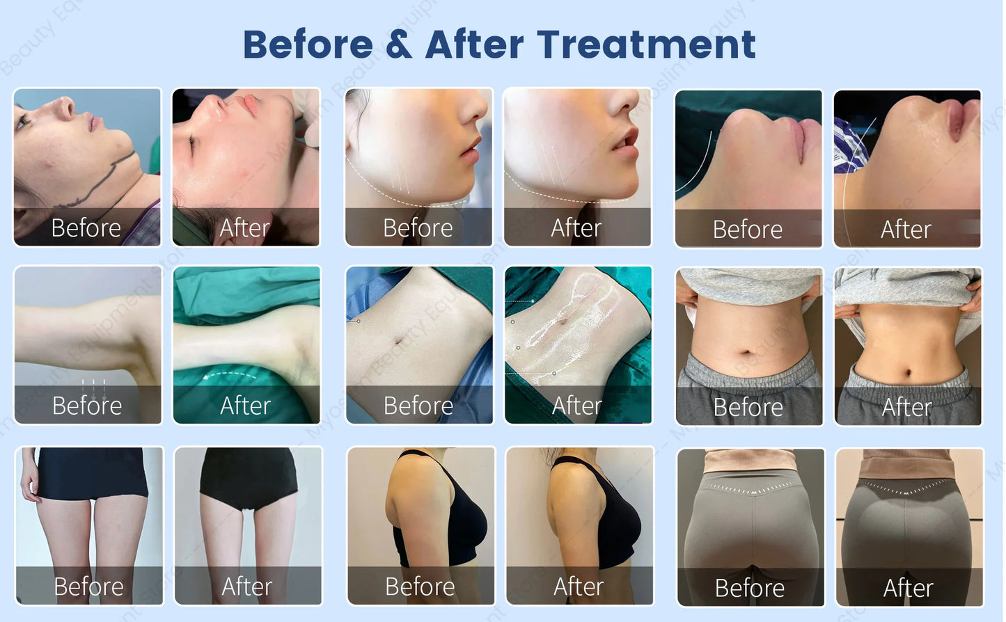 980 nm 1470 nm Dual wavelength Lase Diode Slimming Machine Lipolysis Fat Removal Face Lifting Endo Lift Lipo Lase Equipment